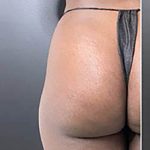 Butt Lift Before & After Patient #13987
