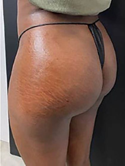 Butt Lift Before & After Patient #13986