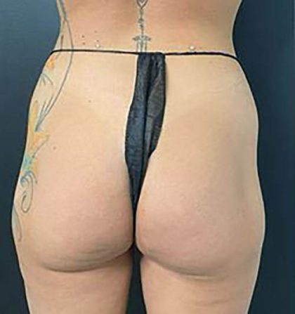 Butt Lift Before & After Patient #13981