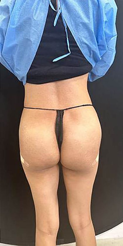 Butt Lift Before & After Patient #13980