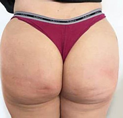 Butt Lift Before & After Patient #13976