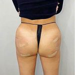 Butt Lift Before & After Patient #13969