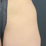 Butt Lift Before & After Patient #13967