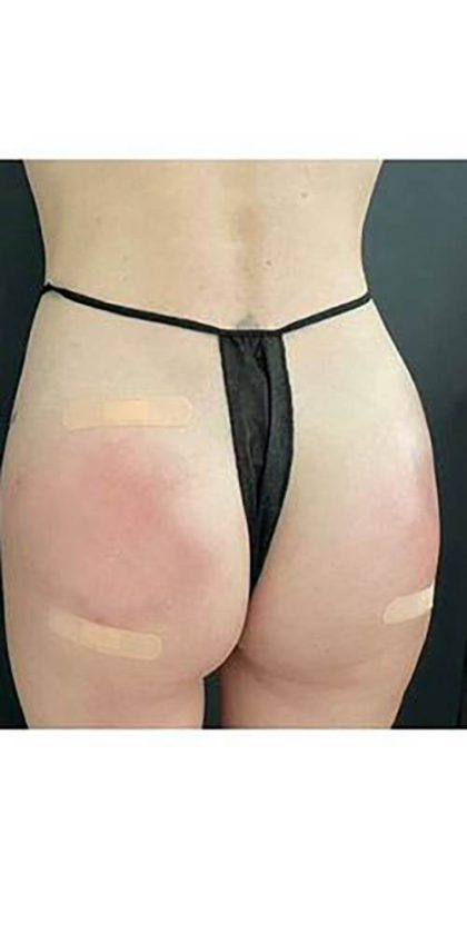 Butt Lift Before & After Patient #13965