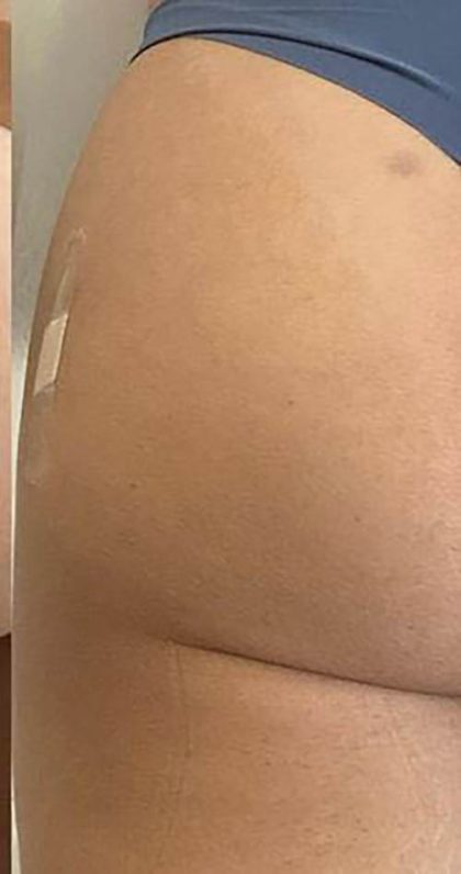 Butt Lift Before & After Patient #14030