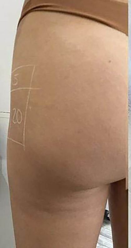 Butt Lift Before & After Patient #14030