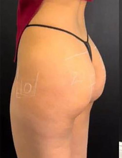 Butt Lift Before & After Patient #14023