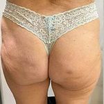 Butt Lift Before & After Patient #14020