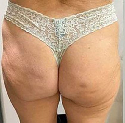 Butt Lift Before & After Patient #14020