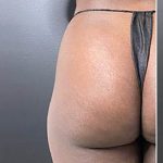 Butt Lift Before & After Patient #14004