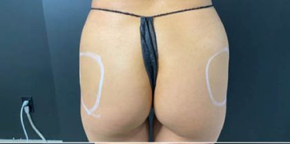 Butt Lift Before & After Patient #14001