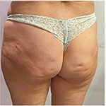 Butt Lift Before & After Patient #13984