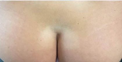 Butt Lift Before & After Patient #13970