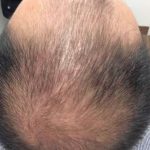 Hair Restoration Before & After Patient #13484