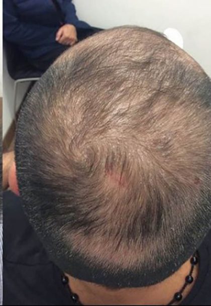Hair Restoration Before & After Patient #13484
