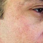 Microneedling Before & After Patient #13274