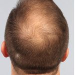 Hair Restoration Before & After Patient #13465