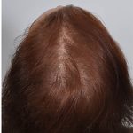 Hair Restoration Before & After Patient #13464