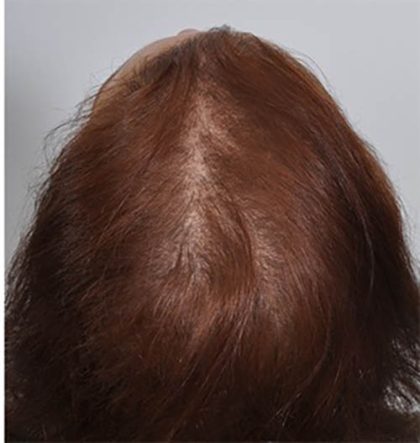 Hair Restoration Before & After Patient #13464
