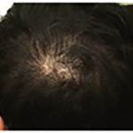 Hair Restoration Before & After Patient #13462