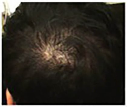 Hair Restoration Before & After Patient #13462