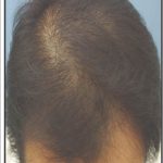 Hair Restoration Before & After Patient #13471