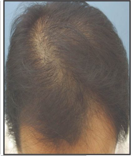 Hair Restoration Before & After Patient #13471