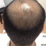 Hair Restoration Before & After Patient #13470