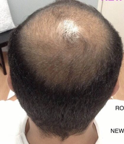 Hair Restoration Before & After Patient #13470
