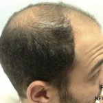 Hair Restoration Before & After Patient #13469
