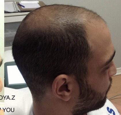 Hair Restoration Before & After Patient #13469