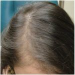 Hair Restoration Before & After Patient #13468