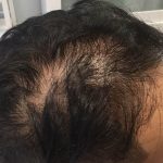 Hair Restoration Before & After Patient #13467
