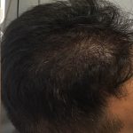 Hair Restoration Before & After Patient #13467