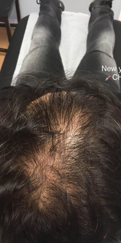 Hair Restoration Before & After Patient #13466