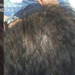 Hair Restoration Before & After Patient #13466