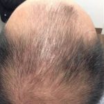 Hair Restoration Before & After Patient #13428