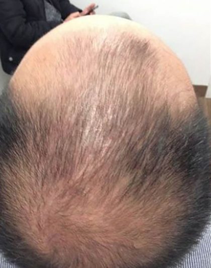 Hair Restoration Before & After Patient #13428