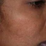 Microneedling Before & After Patient #13247