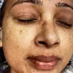 Microneedling Before & After Patient #13246