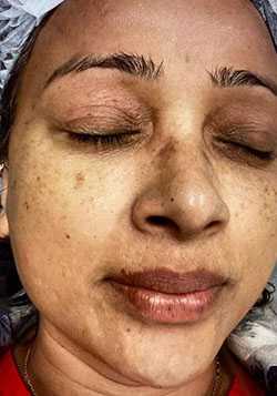 Microneedling Before & After Patient #13246