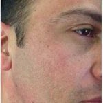 Microneedling Before & After Patient #13263