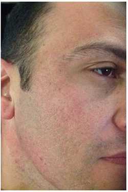 Microneedling Before & After Patient #13263