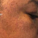 Microneedling Before & After Patient #13269