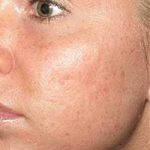 Microneedling Before & After Patient #13266
