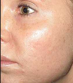 Microneedling Before & After Patient #13266