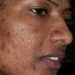 Microneedling Before & After Patient #13270
