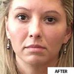 Microneedling Before & After Patient #13265